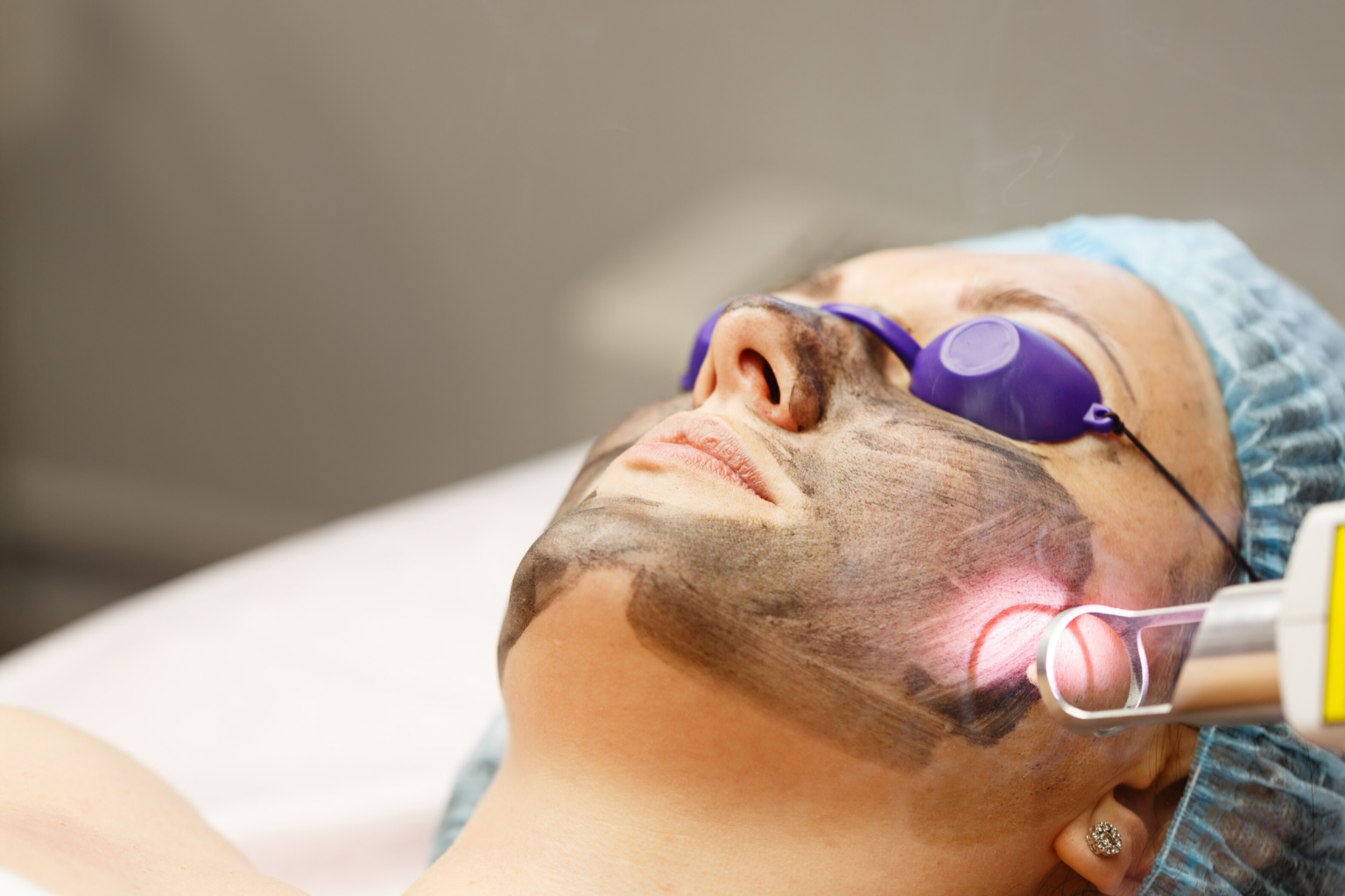 Carbon Laser Facial Treatment Advanced Medical Aesthetics